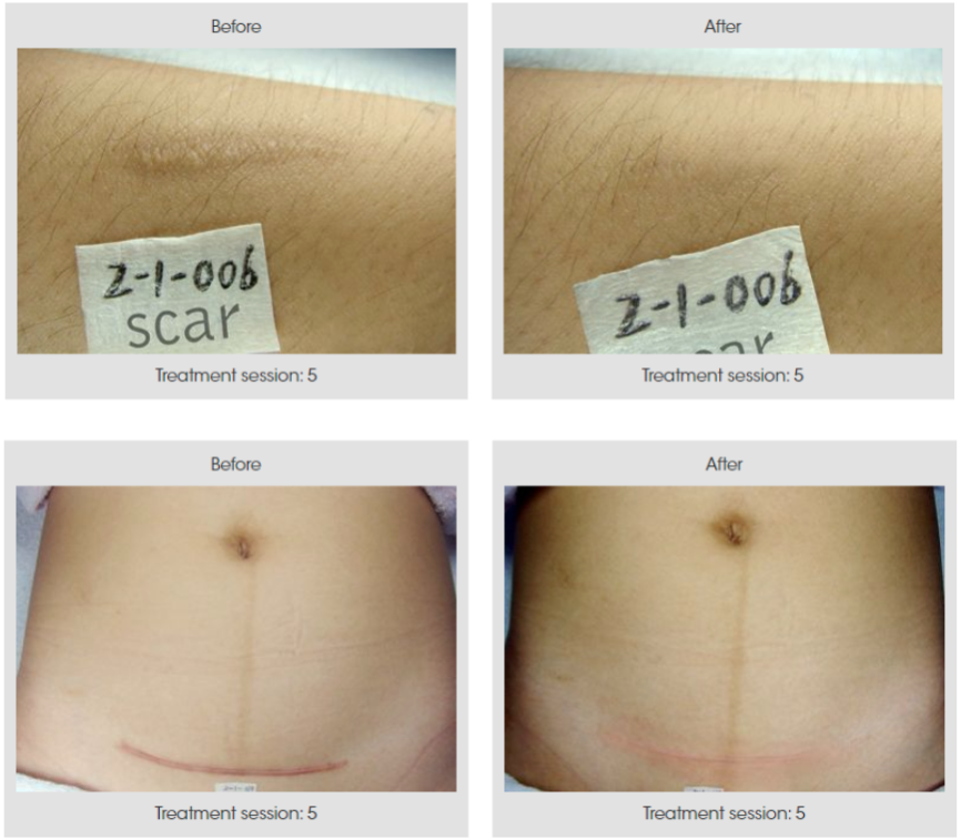 Renas (1550 нм) – фракционный эрбиевый лазер для омоложения и лечения рубцов фото 7