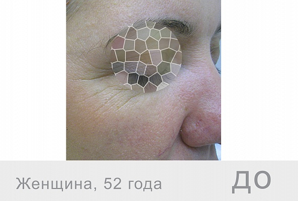 BEAUTELLE Age+ (шприц 2мл) фото 3