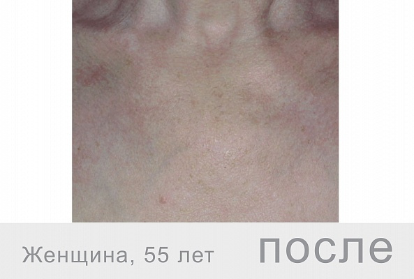 F-XFC FACE Гиалуроновая кислота+ДМАЕ+органический кремний, 10мл фото 4