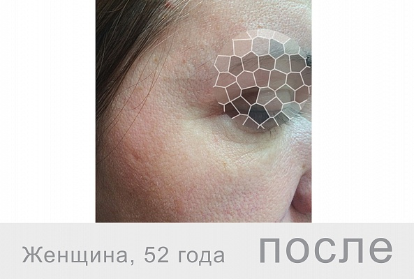 BEAUTELLE Age+ (шприц 2мл) фото 4