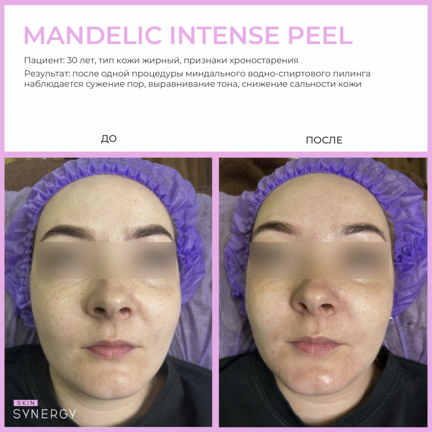 Пилинг Миндальный Интенс\ Mandelic Intense Peel, флакон 30 мл фото 4